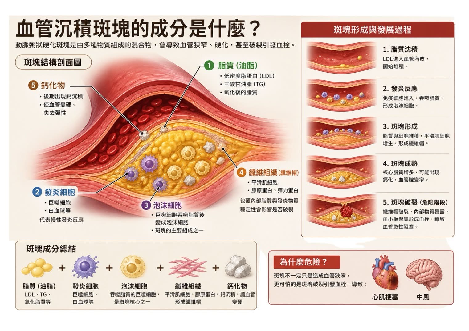 血管斑塊的成分與形成
